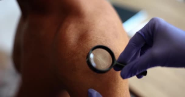 Mãos Médico Luvas Com Uma Lupa Examinar Pele Homem Close — Vídeo de Stock