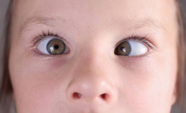 Çocuk suratlı, şaşı ve burnu çilli. Çocuklarda Strabismus neden ve tedavi kavramı