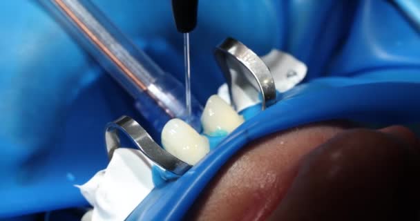 Stříkání Čištění Zubů Instalaci Rovnátka Nebo Dýhy Zubní Služby — Stock video