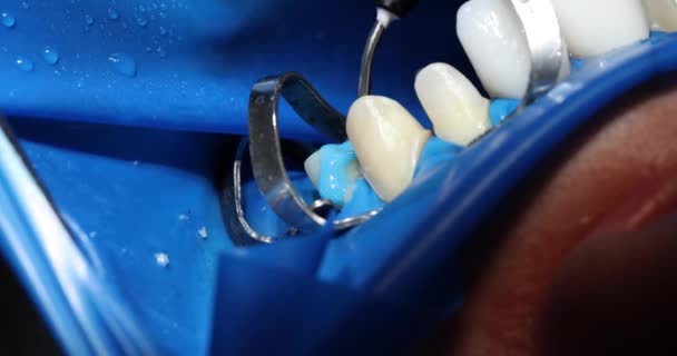 Dentysta Leczy Stomatologiczne Mosty Klinice Ortodontycznej Profesjonalny Lekarz Tworzy Kształt — Wideo stockowe