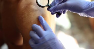 The doctor hands with a magnifying glass above the skin of the shoulder. Sun burn, visit to a dermatologist