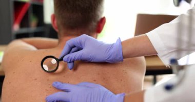 The dermatologist examines the mole on the back with a magnifying glass, close-up, slowmotion. Skin diseases