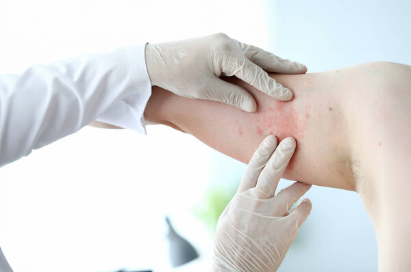 Male doctor in white latex gloves examines patient with skin disease against office background. Allergy treatment concept