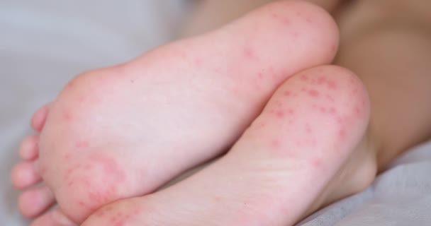 Voeten Van Kind Met Rode Allergische Vlekken Puntjes Voet Enterovirus — Stockvideo