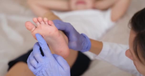 Dokter Mengolesi Gel Krim Pada Kaki Anak Dengan Bintik Alergi — Stok Video