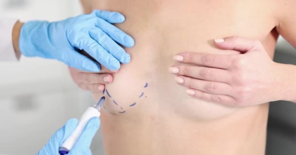 Mãos Cirurgião Plástico Luvas Traçam Linhas Cirúrgicas Peito Bela Mulher — Vídeo de Stock