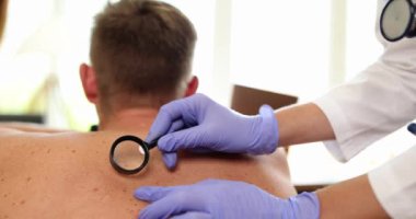 Doktor dermatolog, büyüteçle büyüteç ve ağır çekimde pigmentli nevi üzerinde çalışıyor. Nevus kavramının kötü huyluluğunun belirtileri