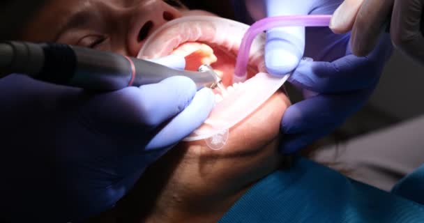 Zubař Připravuje Zuby Pro Instalaci Dýh Korun Pomocí Vrtačky Nahrazení — Stock video