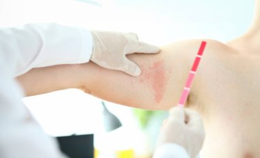 Özel tıbbi eldivenlerle çalışkan erkek ellerine odaklanın ve acı çeken hastanın vücudunda ağrılı ağrıları inceleyin. Profesyonel dermatoloji kliniği reklam konsepti. Bulanık arka plan