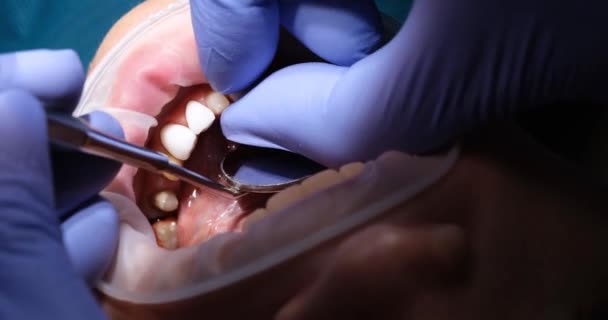 Close Mão Dentista Boca Com Dentes Tratamento Dentário Enchimento Acima — Vídeo de Stock