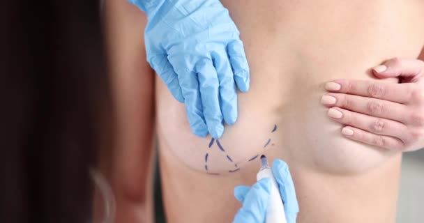 Cirurgião Plástico Enluvado Desenhando Marcações Pré Operatórias Peito Paciente Closeup — Vídeo de Stock
