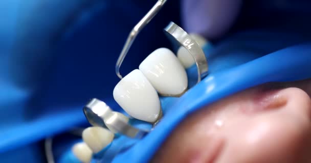 Doctor Orthodontist Dentist Fixing Veneer Patient Teeth Closeup Movie Slow — Stock Video