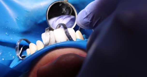 Dentysta Montuje Licówki Zębach Pacjenta Pomocą Metalowych Narzędzi Usługi Protetyczne — Wideo stockowe