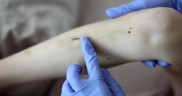 Рана Подряпана Кров Нижній Нозі Лікар Лікує Дитячі Травми Синці — стокове відео