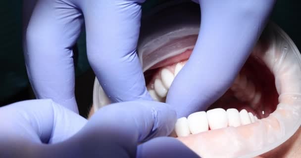 Instalación Chapa Blanca Dientes Mujer Odontología Prótesis Tratamiento Ortodóncico — Vídeo de stock