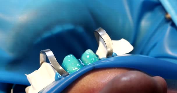 Dentista Aplica Gel Azul Dente Antes Instalar Folheados Close Folheados — Vídeo de Stock