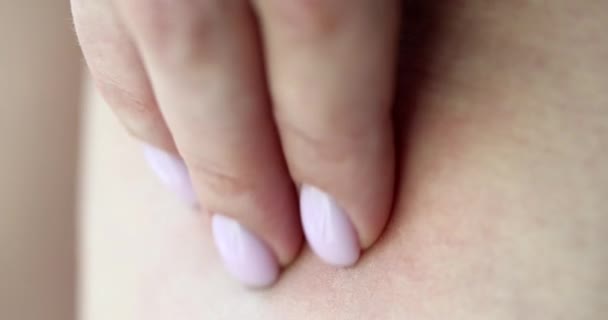 Χέρι Ξύσιμο Φαγούρα Εξάνθημα Του Δέρματος Μετά Τσίμπημα Κουνουπιού Closeup — Αρχείο Βίντεο