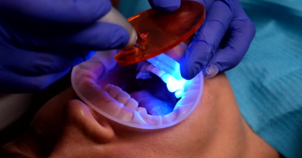 Lékař Zubař Svítící Náplň Pacienta Zub Pomocí Ultrafialového Led Stroje — Stock video