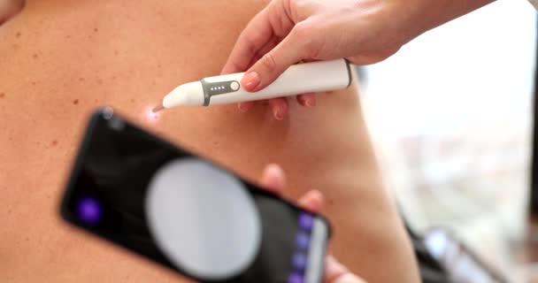 Metoda Dermatoskopie Kožních Formací Molů Vyšetření Prevence Melanomu Karcinomu Kůže — Stock video