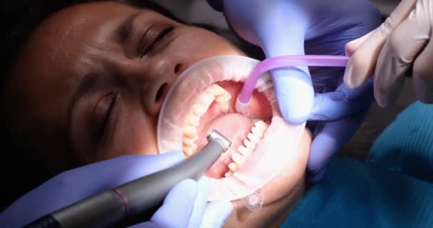 在安装陶瓷牙刷之前 牙科医生先除去牙釉质 正在进行从牙釉质中去除焦油的病人 — 图库视频影像
