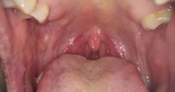 Human Open Mouth Glands Teeth Throat Examination Concept — Stockvideo