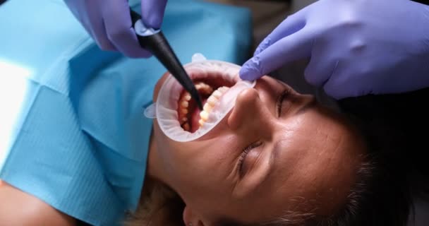 Mulher Com Afastador Boca Clínica Odontológica Escovação Dos Dentes Com — Vídeo de Stock
