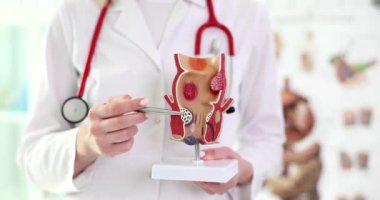 Doktor rektumun anatomik modelini tutuyor, yakın plan. Proktolog muayenesi, hemoroit.