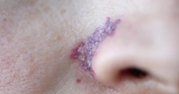 Stav Pokožky Zákroku Odstranění Cévní Sítě Obličeji Rehabilitace Laserovém Opláštění — Stock video