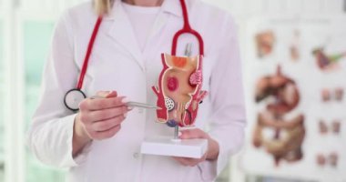 Doktor, iltihaplı vasküler yapıları olan sağlıksız alt rektum modelini tutuyor. Hemoroit problemi