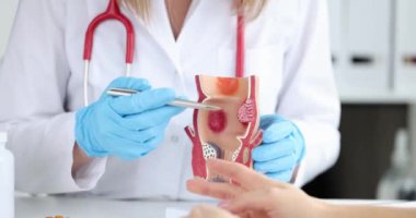 Doktor, iltihaplı vasküler yapıları olan sağlıksız alt rektum modelini tutuyor. Hemoroit kabızlık sorunu ve tedavi