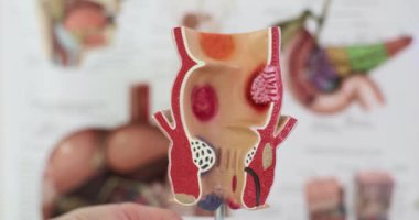 Doktor eli rektumun yapay modelini tutuyor ve insan organlı posterlere karşı patolojiler taşıyor. Vücut anatomisi ve hastalıkları kavramı kısmen ağır çekim