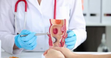 Doctor shows formation of hemorrhoids on model of rectum. Pain syndromes of anus concept