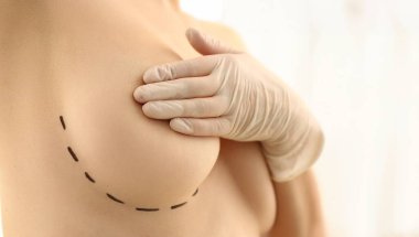 Göğüs ucunu eliyle kapatan, göğüs uçlarında çizgisel işaretler, estetik ameliyat. Hasta güzellik prosedürüne hazırlanıyor. Estetik ameliyat konsepti