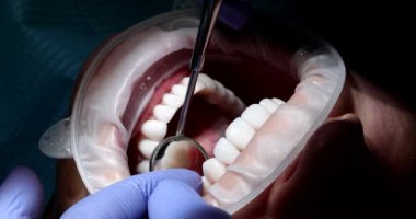 Lastik eldivenli dişçi yansıtıcı ayna kullanarak dişlerin arkasına bakar. Uzman klinikteki hastaların çürüklerini düzenli olarak kontrol ediyor.