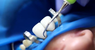 Diş hekimi sivri diş teçhizatı kullanarak beyaz seramik kaplamaları hastanın dişlerinden çıkarıyor. Klinikte yavaş çekimde insan boşluğuna profesyonel bakım