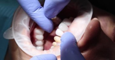 Diş hekimi hasta dişlerine baskı yapar ve ameliyattan önce hassasiyeti kontrol eder. Doktor ağız boşluğundaki plağı çıkarmak için ultrasonik temizleyici kullanıyor.