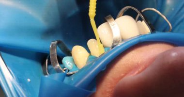 Diş hekimi dişlerindeki plağı çıkarmak için diş fırçası kullanıyor. Klinikte sakız sağlığını yavaş çekimde korumak için profesyonel diş sağlığı hizmetleri