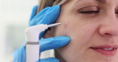 Dermatolog hastanın yüzündeki sivilceyi temizlemek için lazer kullanıyor. Doktor çevresindeki hasarı azaltmak ve en aza indirmek için lekeleri hedef alıyor.