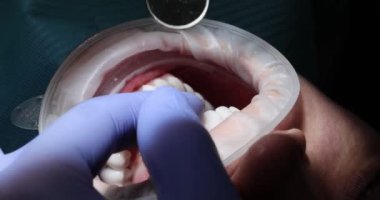 Doktor, diş kliniğinde hasta dişlerini küçük aynayla muayene ediyor. Diş hekimi, tıbbi işlemler sırasında ağız boşluğuna bakar.