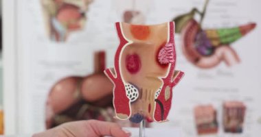 Anatomy of anus and treatment of diseases of rectum with hemorrhoids. Proctologist and rectal pathology on anatomical model