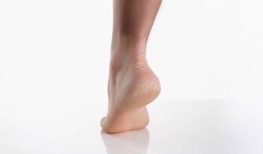 Tek bir kadın bacağı ya da topuğu kurumuş derili kurumuş topuğu gösteriyor. Kış mevsiminde kadın topukları çatlamış. Sağlık, kişisel bakım konsepti.