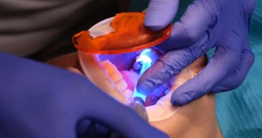 Steril eldivenli diş hekimi ameliyat sırasında dişlerinde ultraviyole ışığı kullanır. Sıhhiye acıyı azaltmak için tedavi çözümü sağlar