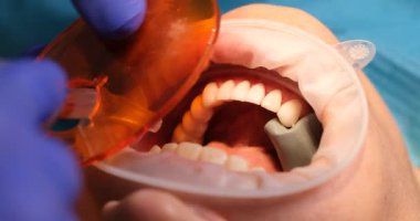 Diş hekimi hasta dişlerine ultraviyole ışık kullanarak diş macunu sürüyor. Eldivenli sıhhiye açık ağızda çalışır dişçilikte tedavi prosedürü yapar