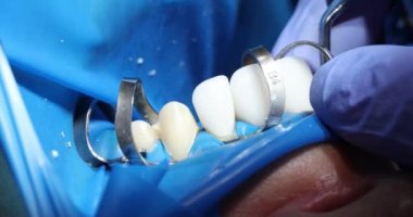 Diş hekimi, dişçilikteki hasta dişlerine diş kaplaması uygular. Doktor lateks eldivenleri teslim ederken ağız boşluğunda dikkatli davranır.
