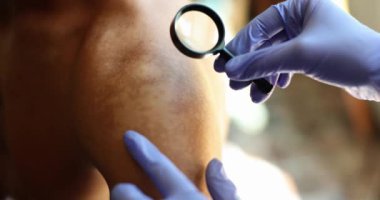 Eldivenli doktor cildinde vitiligo ya da deri döküntüsü olup olmadığını kontrol eder. Erkeğin omzunda kahverengi benekler var.