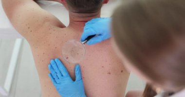 Kadın dermatolog, hastanın sırt derisini büyüteç kullanarak muayene ediyor. Dikkatli bir doktor muayene sırasında cilt tümörü belirtilerine bakar.