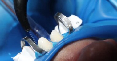 Diş hekimi, tedavi prosedürüne hazırlanan hastaların dişlerine su döker. Diş hekimi diş mineleri hastaların ağzında çalışıyor.