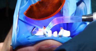 Nitelikli dişçi, hastanın dişlerindeki plağı çıkarmak için ultrasonik pulluk kullanır. Deneyimli doktor dişlerin doğal parlaklığını geri kazandırır