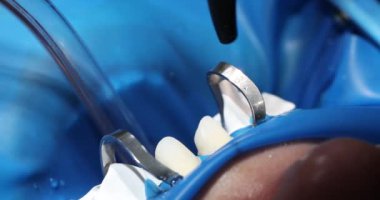 Profesyonel dişçi hastaların dişlerini kurutmak için hava akımını kullanır. Doktor kalan nemi çıkarmak için dişlere hava akışını yönlendirir.