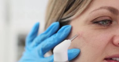 Dermatolog akne yarasını temizlemek için lazer teknolojisini dikkatlice kullanıyor. Sarışın kadın hasta özel klinikte acısız cilt bakımından hoşlanır.
